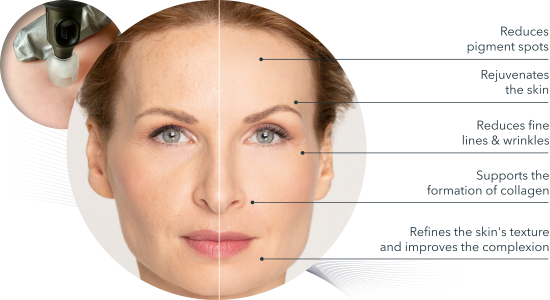 Microneedling_Produktbild03_VorherNacher_3