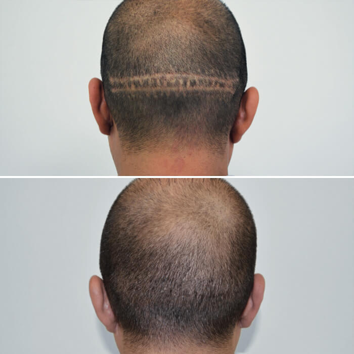 before and after picture of a man's scalp with amiea micropigmentation 