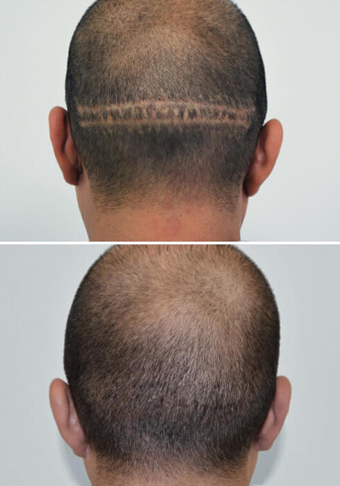 before and after picture of a man's scalp with amiea micropigmentation 