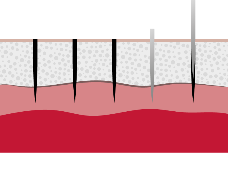 Querschnitt der Haut bei einer Permanent-Make-up-Behandlung, grafische Darstellung